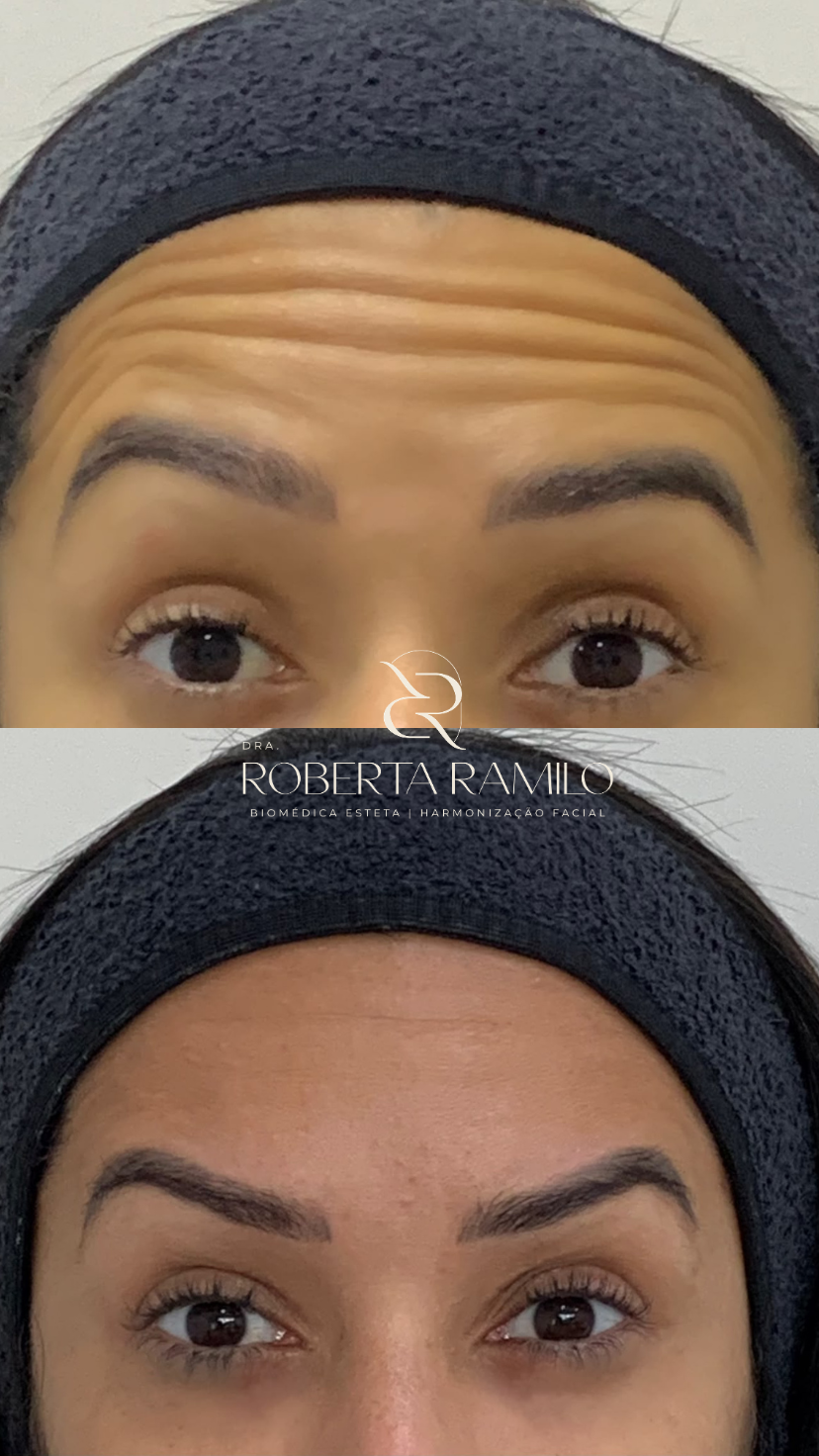 Resultado de toxina botulínica