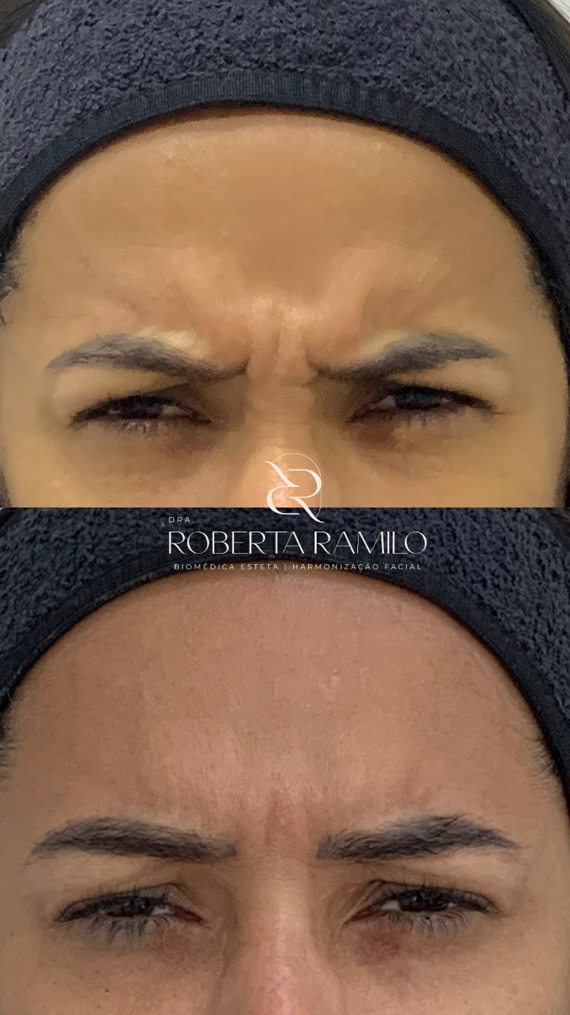 Outro resultado de toxina botulínica