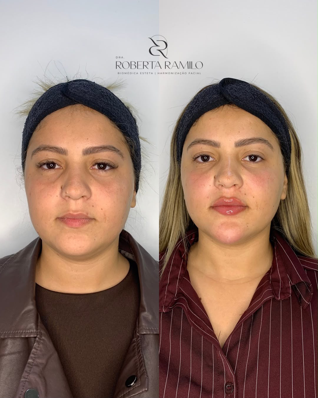Antes e depois de harmonização facial