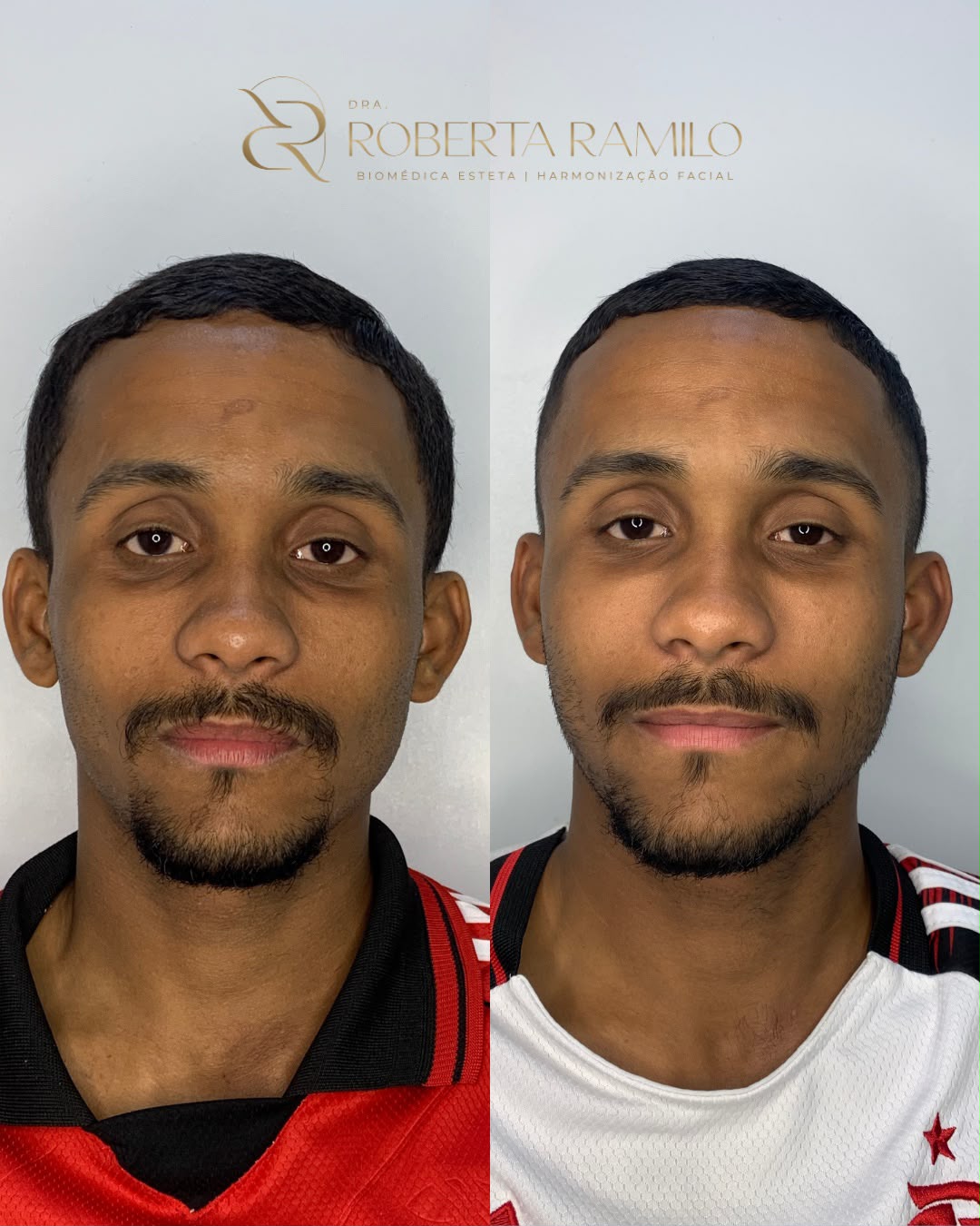 Antes e depois de preenchimento de olheiras e região malar