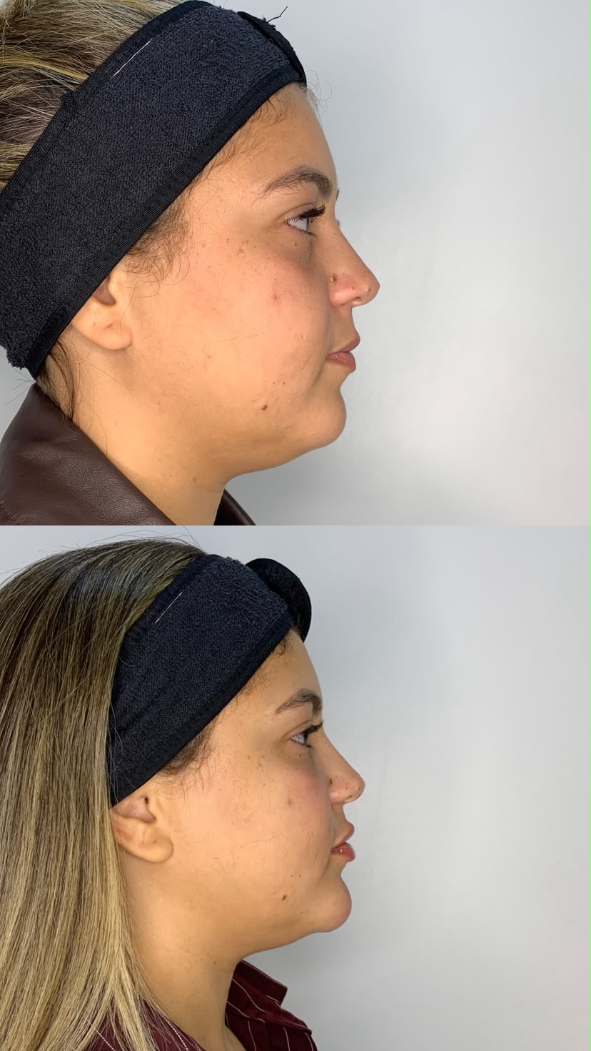 Antes e depois de preenchimento de mento