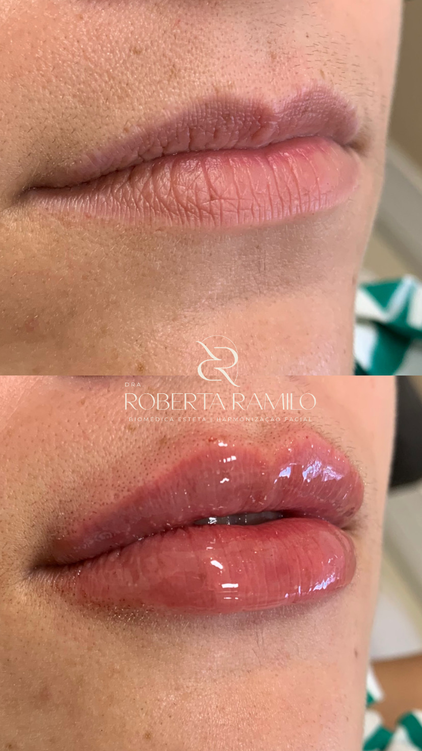 Resultado de preenchimento labial