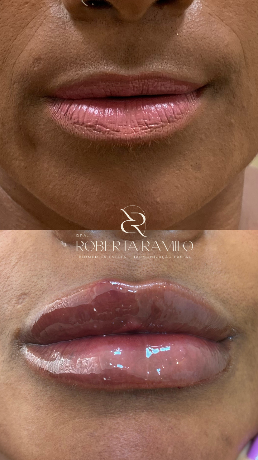 Outro resultado de preenchimento labial