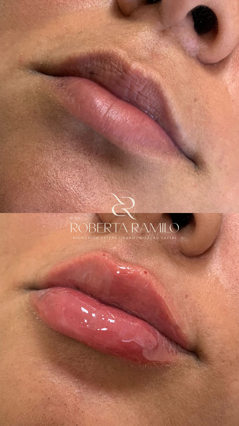 Outro resultado de preenchimento labial
