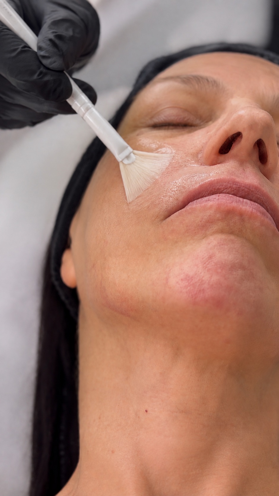 Resultado de tratamento de skincare